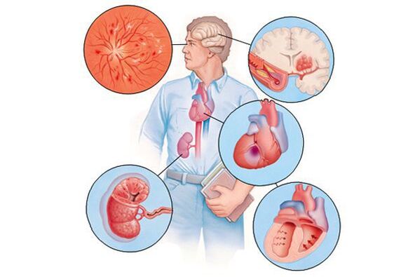 Schade aan verschillende organen met langdurige arteriële hypertensie